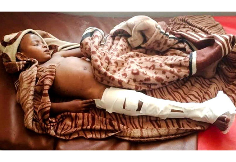 A child receives care at a hospital in the town of Dedebit, following a reported airstrike