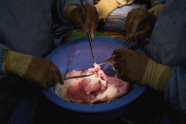 In this photo provided by NYU Langone Health, surgeons prepare a genetically modified pig heart for transplant into a recently deceased donor at NYU Langone Health on Wednesday, July 6, 2022, in New York.