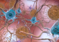 This illustration made available by the National Institute on Aging/National Institutes of Health depicts cells in an Alzheimer's-affected brain. An experimental drug modestly slowed the brain disease's progression, researchers reported Tuesday. NATIONAL INSTITUTE ON AGING, NIH/AP
