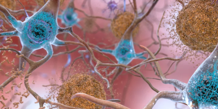 This illustration made available by the National Institute on Aging/National Institutes of Health depicts cells in an Alzheimer's-affected brain. An experimental drug modestly slowed the brain disease's progression, researchers reported Tuesday. NATIONAL INSTITUTE ON AGING, NIH/AP