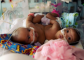 Amanda Arciniega and James Finley's conjoined twin daughters, JamieLynn and AimeeLynn, underwent separation surgery at Cook Children's Medical Center in Fort Worth, Texas. Courtesy of Cook Children's Medical Center
