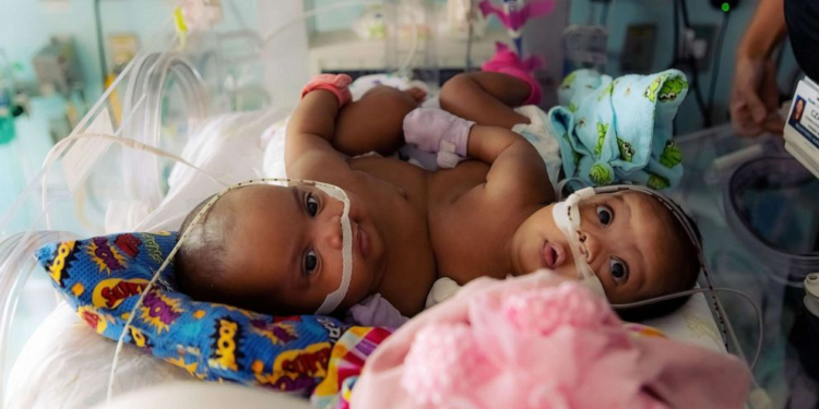 Amanda Arciniega and James Finley's conjoined twin daughters, JamieLynn and AimeeLynn, underwent separation surgery at Cook Children's Medical Center in Fort Worth, Texas. Courtesy of Cook Children's Medical Center