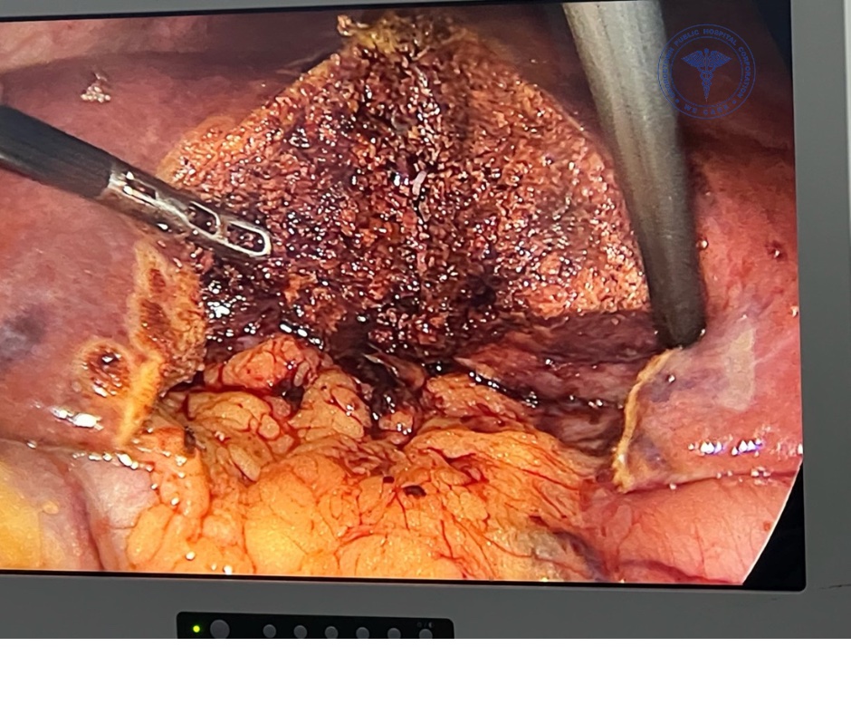 Laparoscopic Liver Resection
