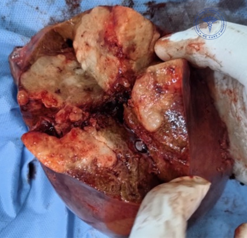 Resected liver metastatic tumor
