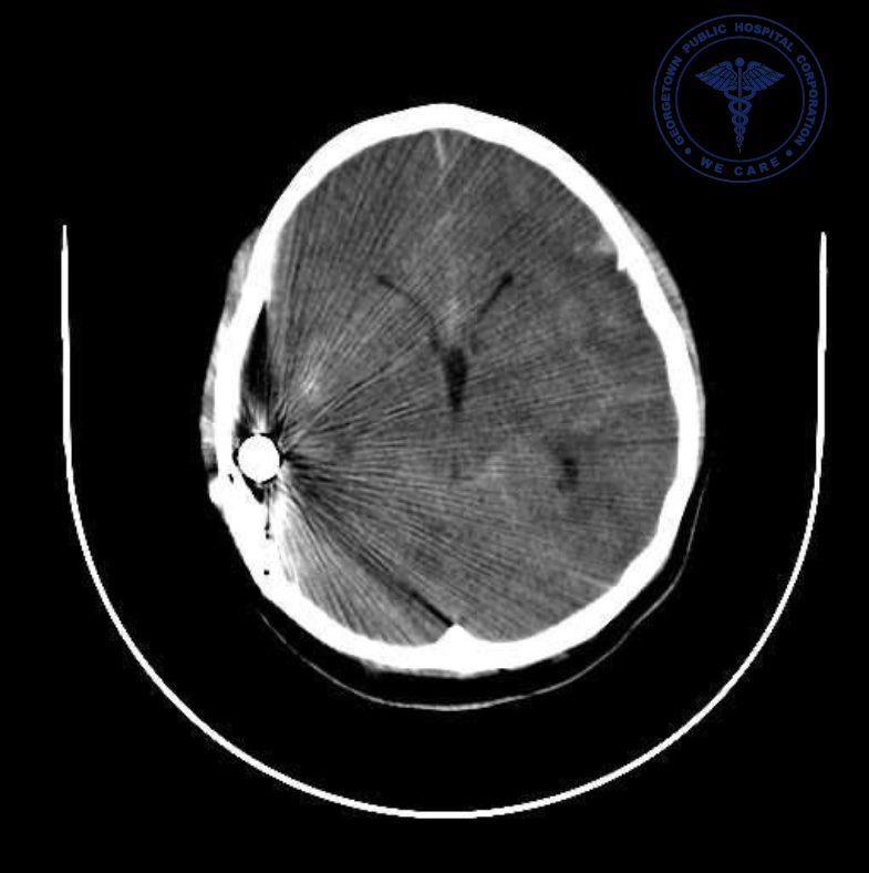 The warhead lodged in the child's brain