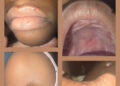 Children of Mon Repos, East Coast Demerara presenting with symptoms associated with Foot, Hand and Mouth Disease.