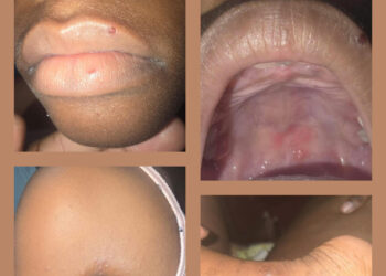 Children of Mon Repos, East Coast Demerara presenting with symptoms associated with Foot, Hand and Mouth Disease.