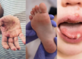 Symptoms of Hand, foot and mouth disease (Google photo)