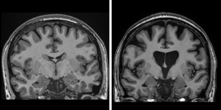Two brain scans side-by-side. The one on the left is healthy, the one on the right shows loss of brain matter as neurons die in Huntington's disease.