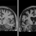Two brain scans side-by-side. The one on the left is healthy, the one on the right shows loss of brain matter as neurons die in Huntington's disease.